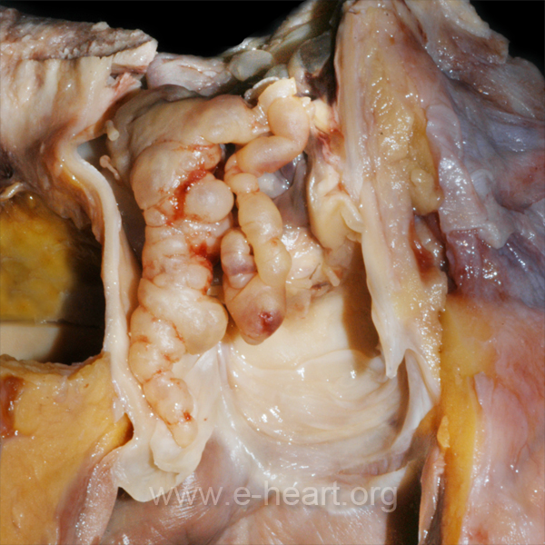 Pulmonary Intimal Sarcoma